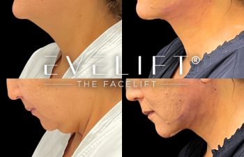 female patient before and after EVELift®