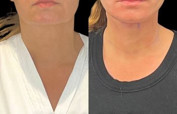 female patient before and after EVELift®