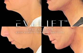 female patient before and after EVELift®