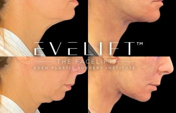 female patient before and after EVELift®