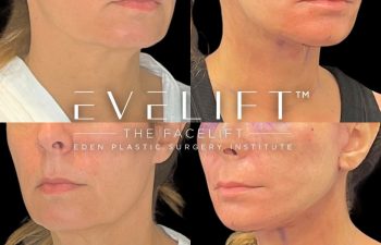 female patient before and after EVELift®
