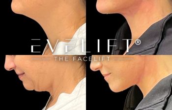 female patient before and after EVELift®