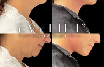 female patient before and after EVELift®