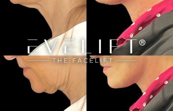 female patient before and after EVELift®