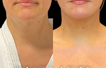 female patient before and after EVELift®