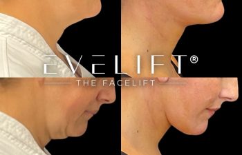female patient before and after EVELift®