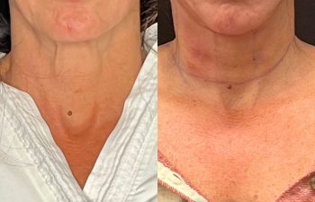 female patient before and after EVELift®