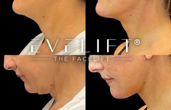female patient before and after EVELift®
