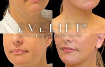 female patient before and after EVELift®
