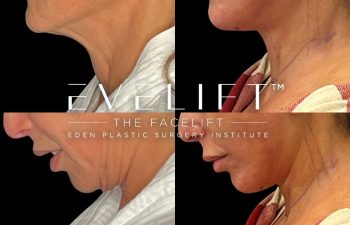 female patient before and after EVELift®
