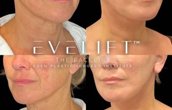 female patient before and after EVELift®