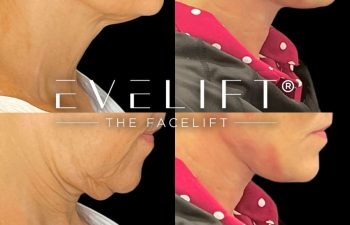 female patient before and after EVELift®