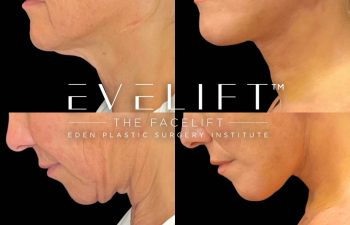 female patient before and after EVELift®