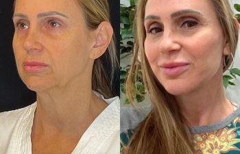 female patient before and after EVELift®