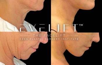 female patient before and after EVELift®