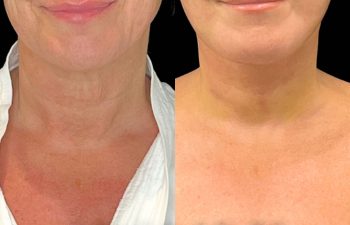 female patient before and after EVELift®