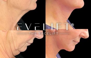 female patient before and after EVELift®
