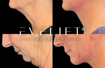 female patient before and after EVELift®