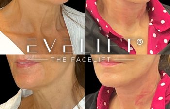 female patient before and after EVELift®