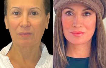 female patient before and after EVELift®