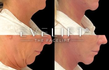 female patient before and after EVELift®