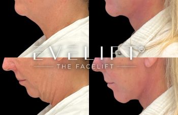 female patient before and after EVELift®