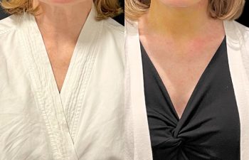 female patient before and after EVELift®