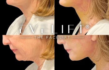 female patient before and after EVELift®