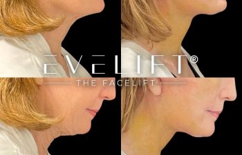 female patient before and after EVELift®