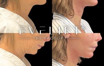 female patient before and after EVELift®