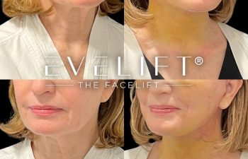 female patient before and after EVELift®