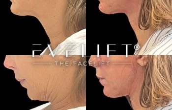 female patient before and after EVELift®