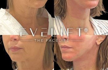 female patient before and after EVELift®