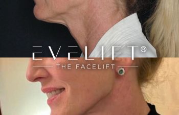 female patient before and after EVELift®