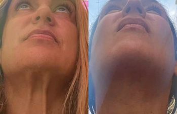 female patient before and after EVELift®