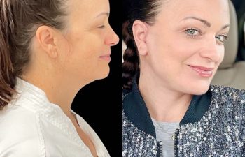 female patient before and after EVELift®