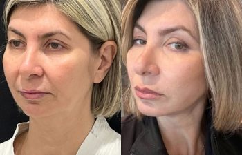 female patient before and after EVELift®