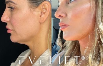 female patient before and after EVELift®