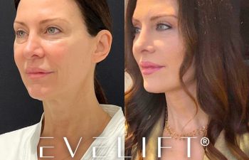 female patient before and after EVELift®