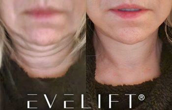 female patient before and after EVELift®