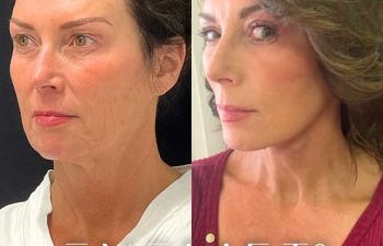 female patient before and after EVELift®