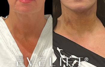 female patient before and after EVELift®