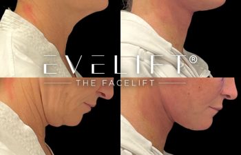 female patient before and after EVELift®
