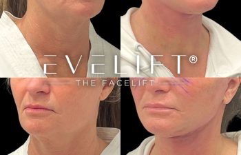 female patient before and after EVELift®