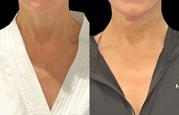 female patient before and after EVELift®