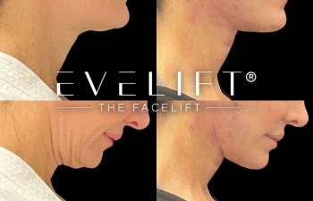 female patient before and after EVELift®