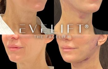 female patient before and after EVELift®