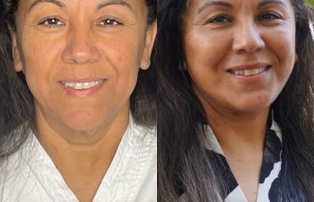 female patient before and after EVELift®