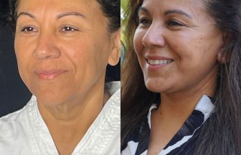 female patient before and after EVELift®