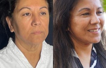 female patient before and after EVELift®
